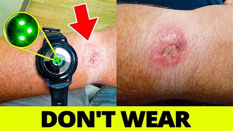 skin irritation from wearing watch.